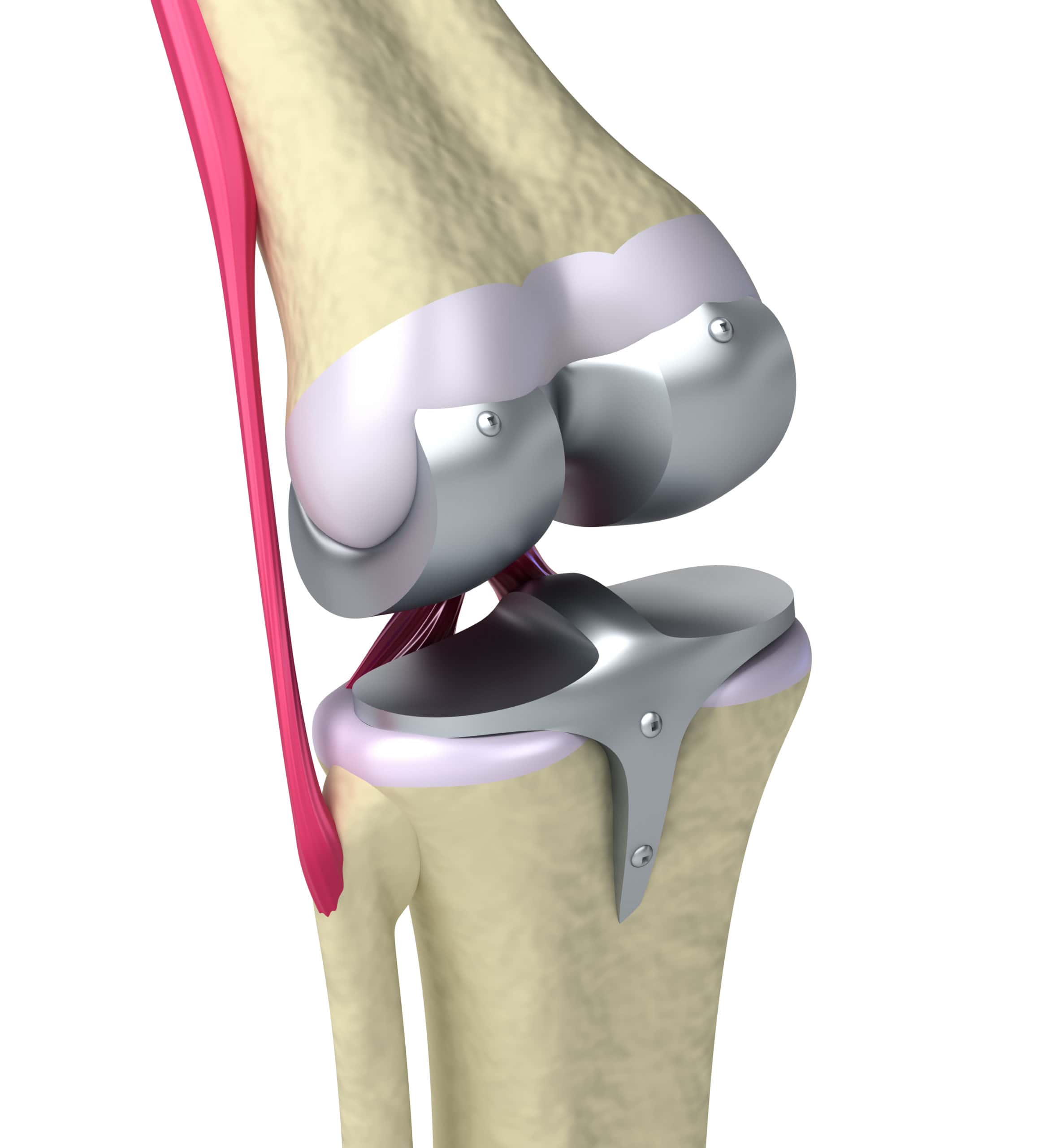 Disco de polimento médico para prótese de joelho